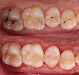 Кариес зубов: методы лечения, профилактика для белоснежной улыбки